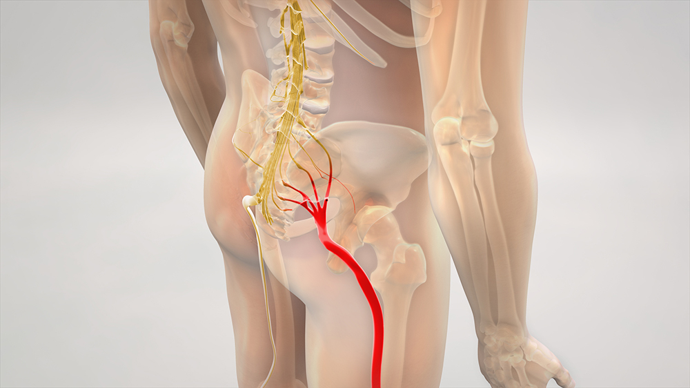 Sciatica pain