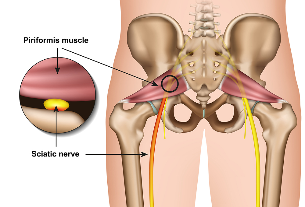 Image of body showing sciatica